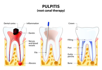 How Root Canal Therapy Can Help Injured Teeth